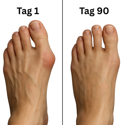 BallenFix Hallux Valgus Korrektur